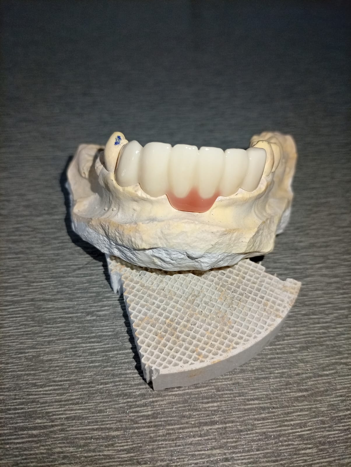 Bilateral Akers Clasp Design in 3D