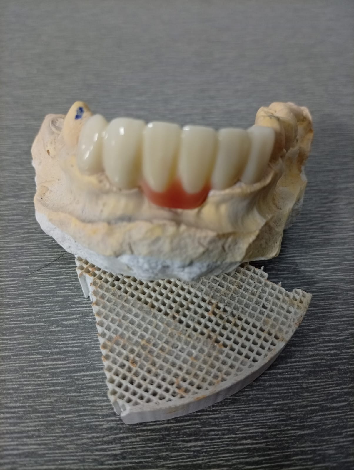 Mandibular Anterior Prep Cast