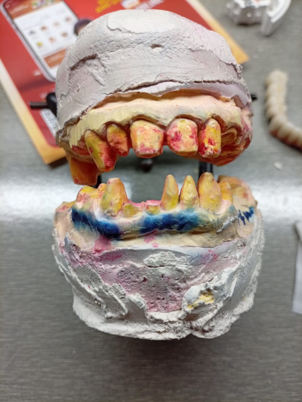 Mandibular Anterior Bridge with Pink Ceramic