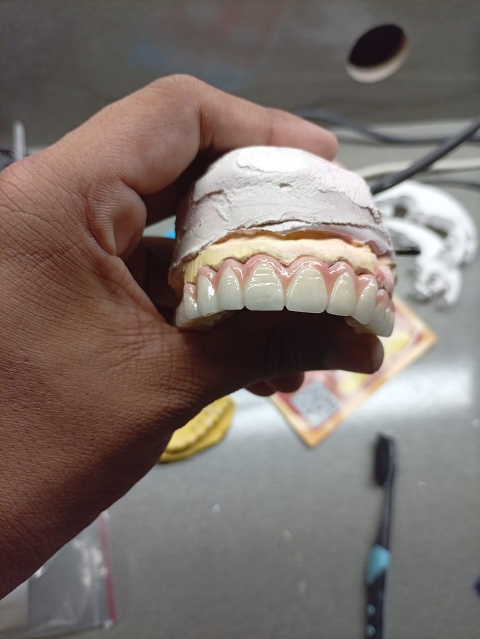 Maxillary Anterior B1 Shade Bridge