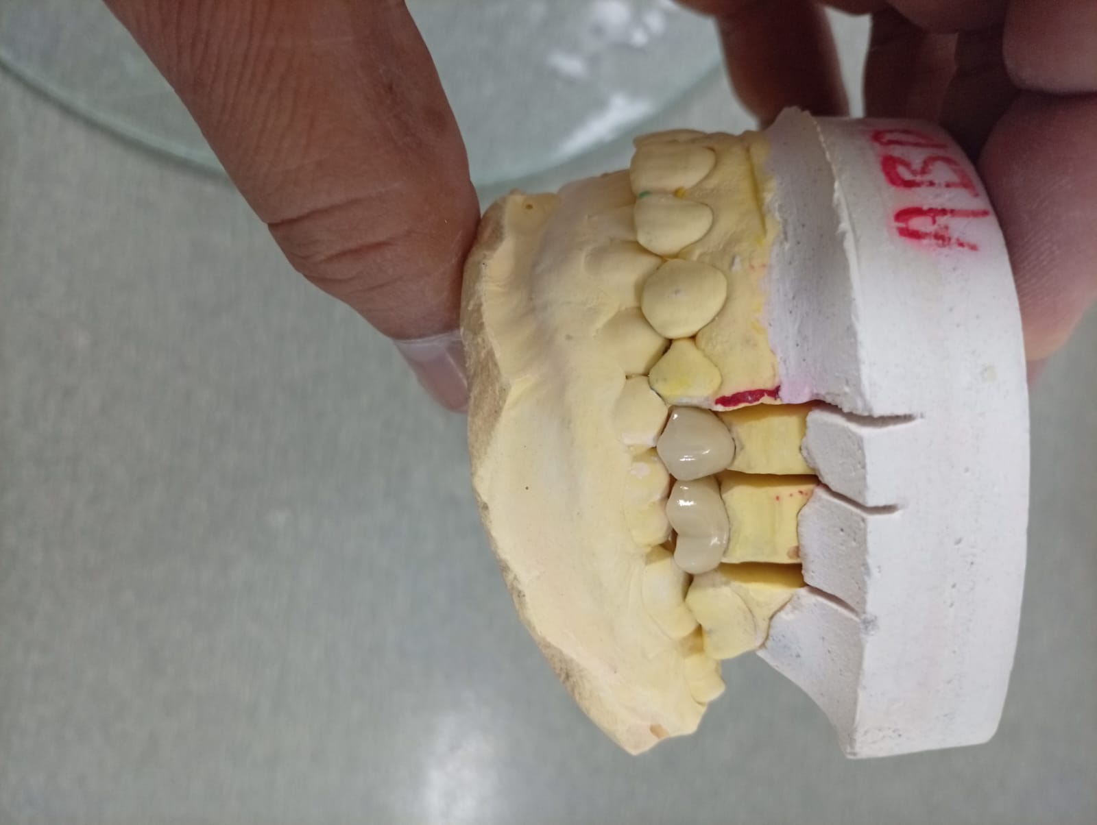 Posterior Molar Bridge Model Seating