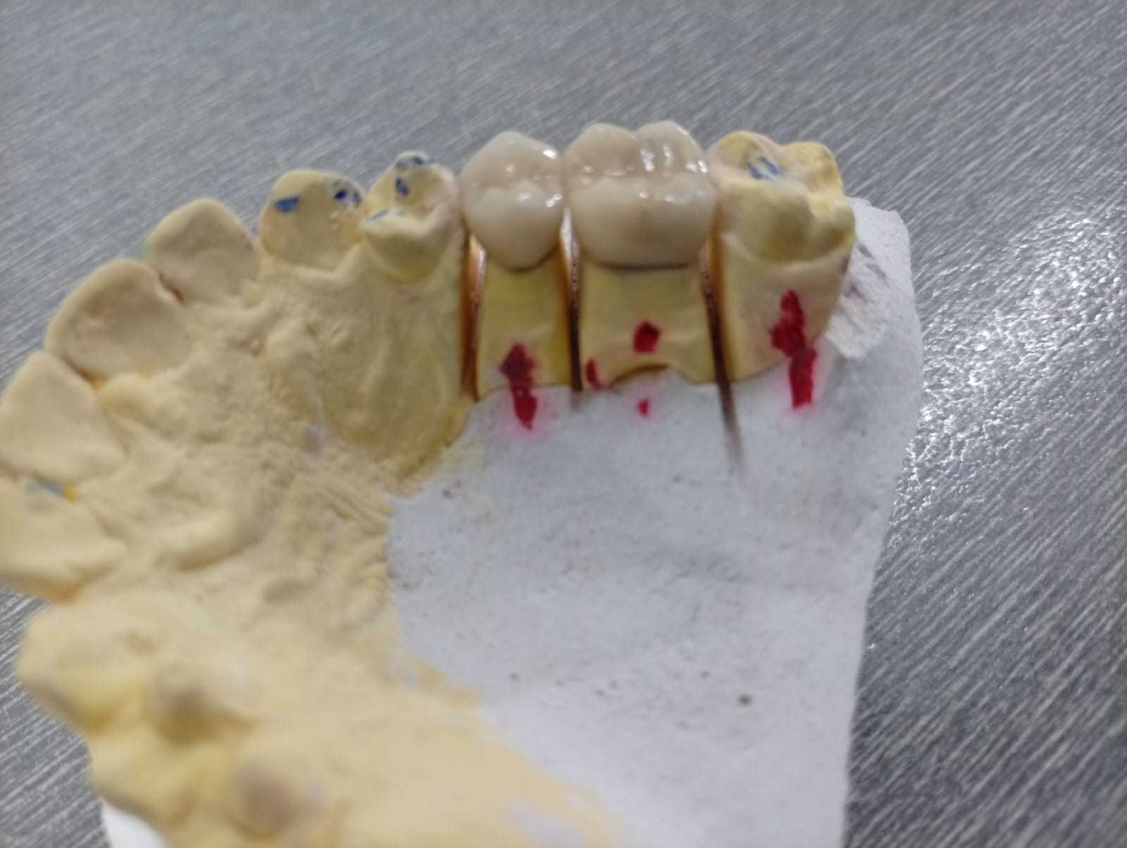 Occlusal Articulating Contact Verification
