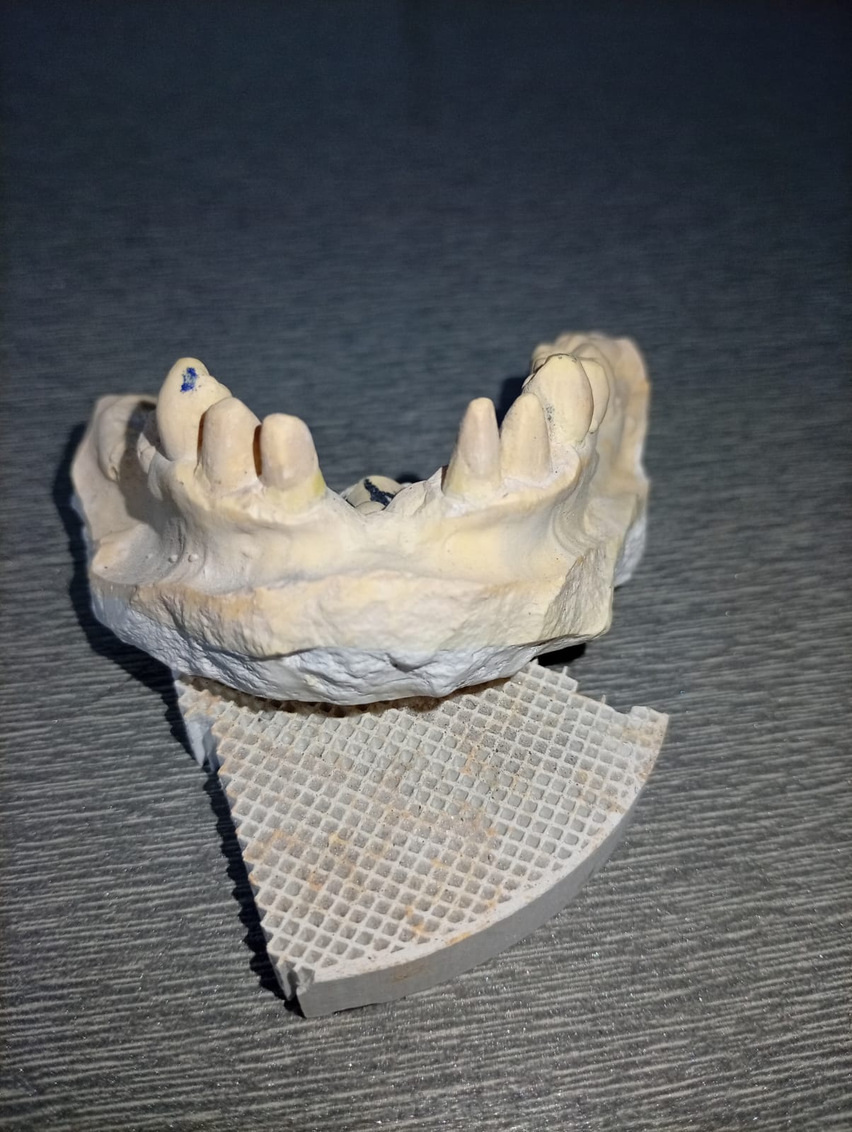 Maxillary Anterior Framework Alignment